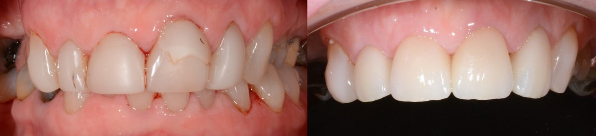 Old front crowns with dark margins, chipped porcelain and inflamed gums, and the same teeth after the crowns were replaced