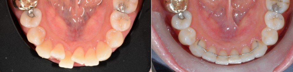 The lower front teeth before treatment, and afterwards with a fixed retainer wire bonded behind them