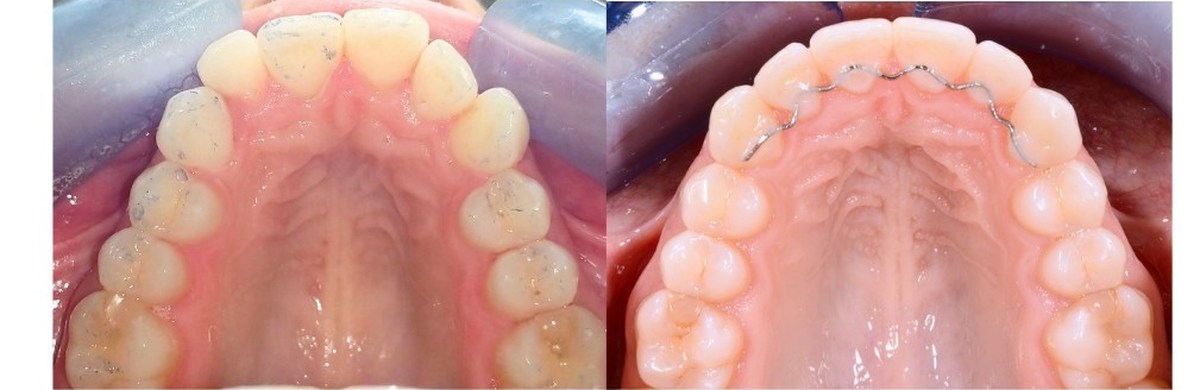 The upper arch before treatment, and afterwards with a fixed retainer wire bonded behind the front teeth