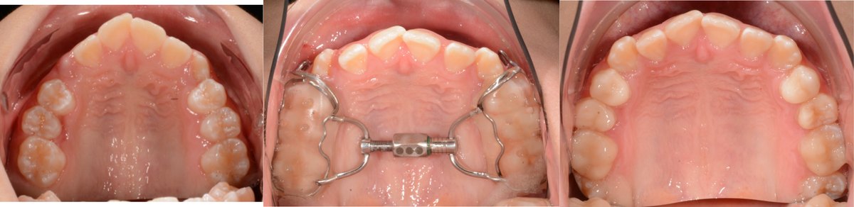 The upper arch before treatment, with a bonded expander in place covering the biting surfaces of the back teeth, and after treatment