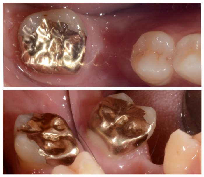 Gold onlays protecting the chewing surfaces of back teeth