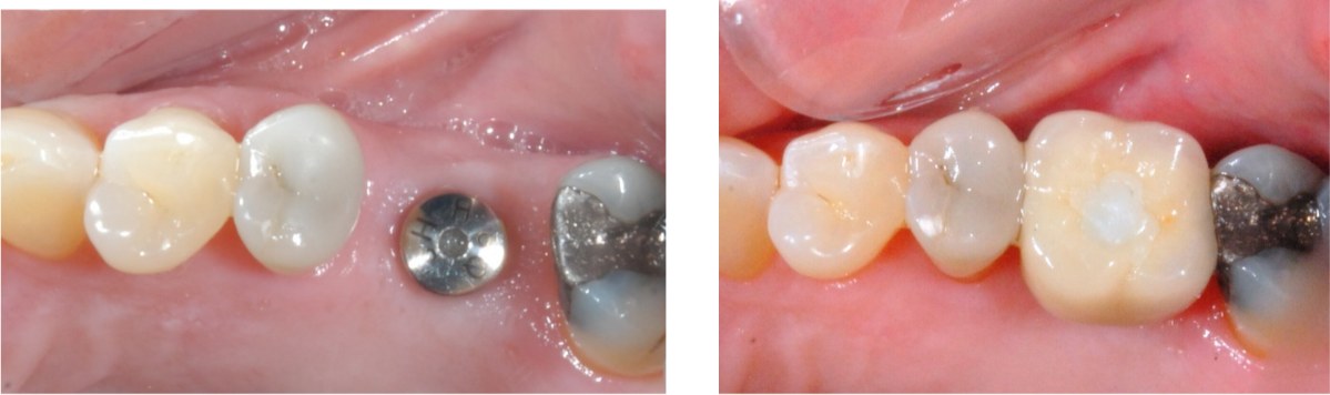 An implant abutment in place in the gum where a back tooth was missing, and the finished crown fitted onto it