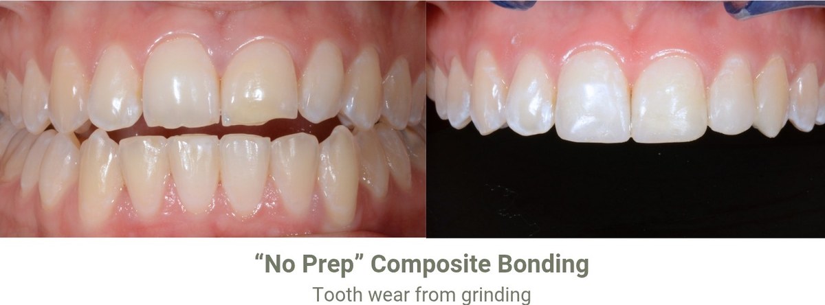 Upper front teeth worn short from grinding, and the same teeth after no prep composite bonding restored their length