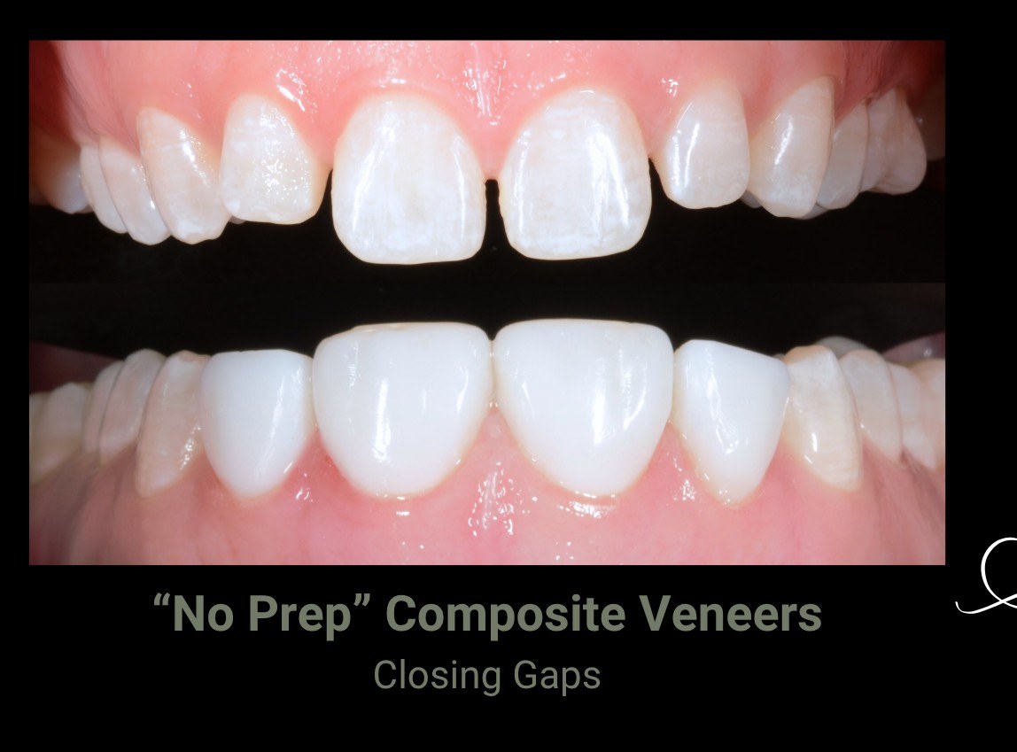 A gap between the upper front teeth before treatment, and the same teeth after no prep composite veneers closed it