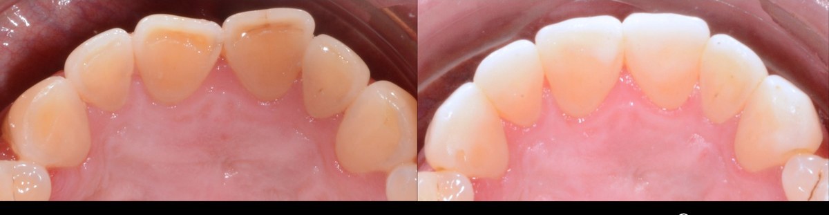 The inner surfaces of the upper front teeth worn and yellowed before treatment, and the same teeth after being restored