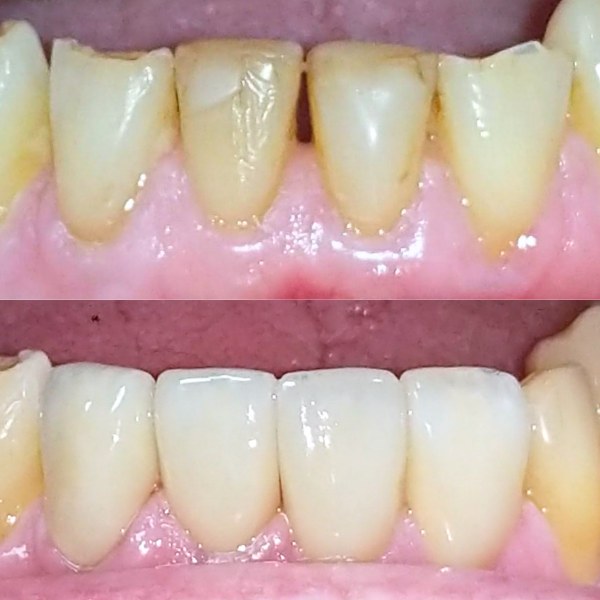 Worn and discoloured lower front teeth before treatment, and the same teeth after porcelain veneers were fitted