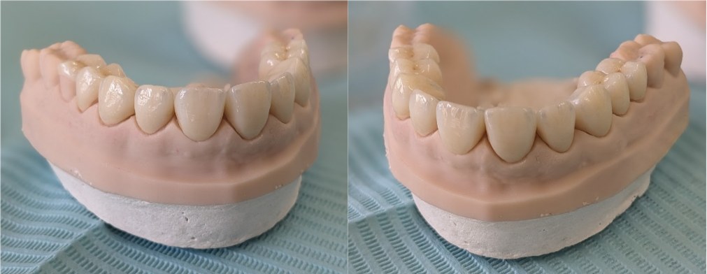Two views of finished porcelain crowns for the upper front teeth, seated on the working model ready to be fitted