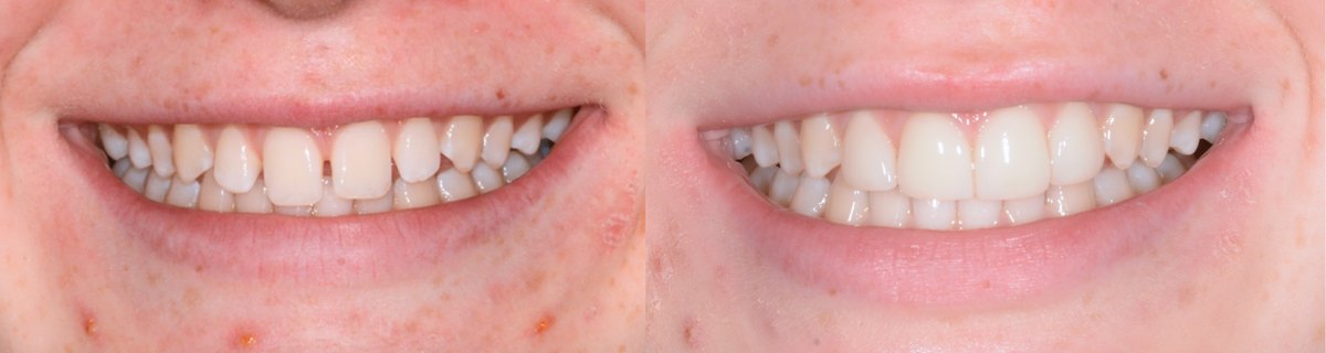 Spaces between the upper front teeth before treatment, and the same teeth after porcelain veneers were fitted