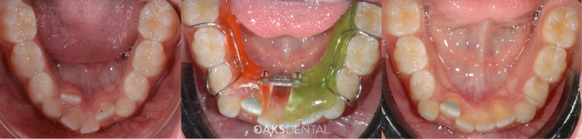 The lower arch before treatment, with a removable lower expander in place, and after treatment