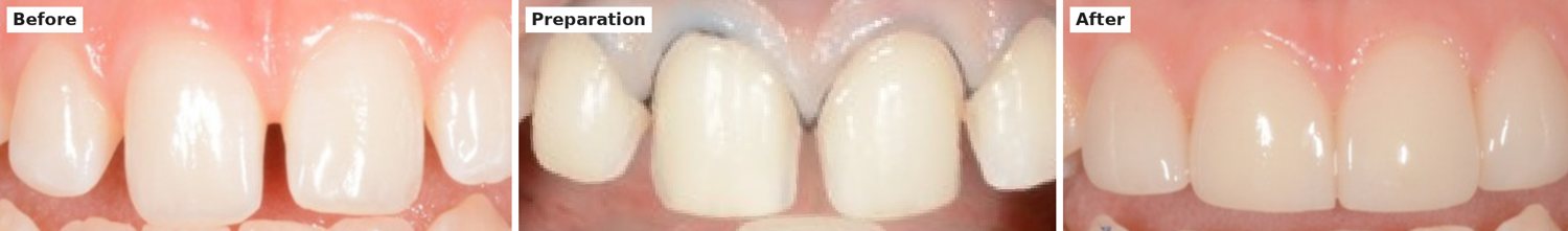 Before, preparation and after: a gap between the upper front teeth closed with veneers after fine trimming of the front surfaces
