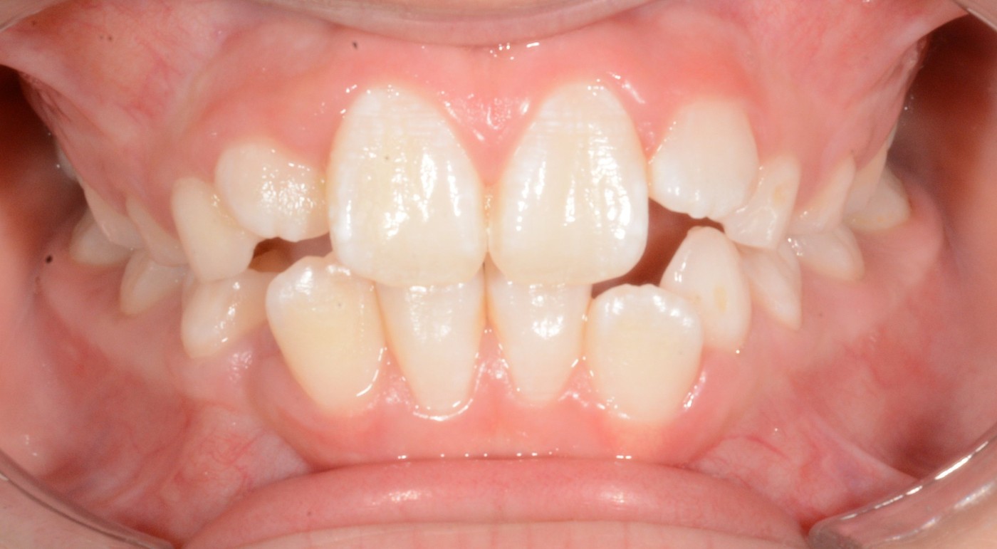 A child's teeth with the back teeth together and a gap between the upper and lower front teeth