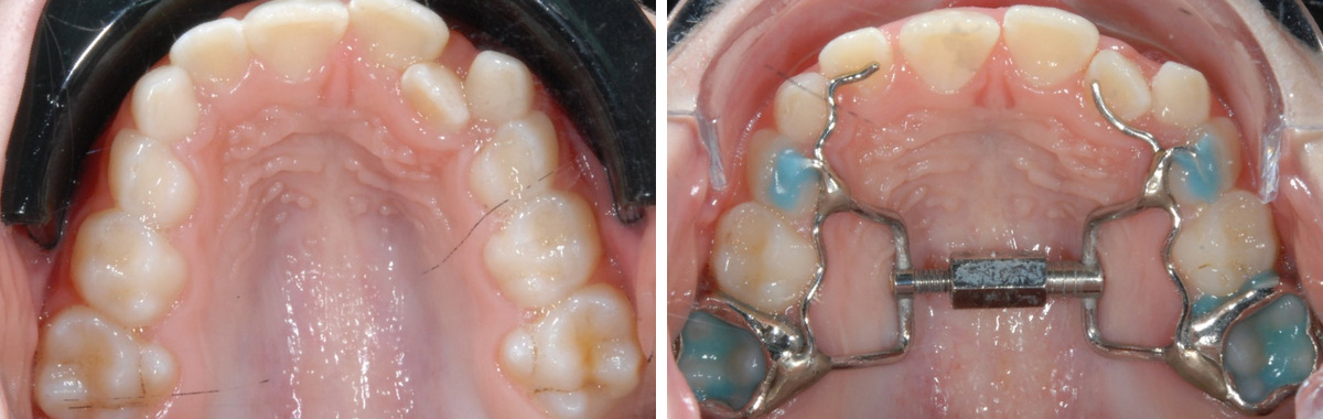 An upper arch before treatment beside the same arch with a banded hyrax expander cemented to the back teeth
