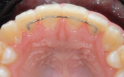 Why Teeth Move Back, and What Retainers Actually Do