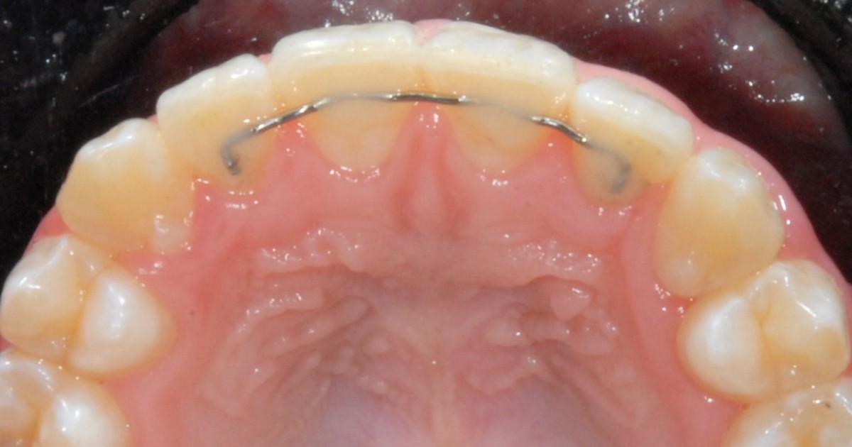 Bonded retainer behind the upper front teeth A fixed retainer wire bonded behind the upper front teeth, seen from above