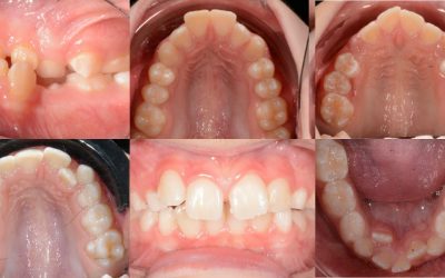 Does My Child Need Early Orthodontics? A Guide for Parents of 6-to-10-Year-Olds