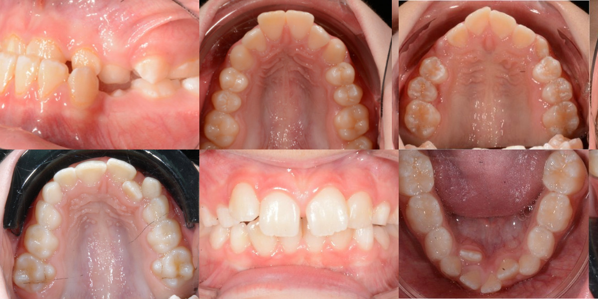 Six untreated presentations seen before early orthodontic treatment Six intraoral photographs showing crossbite, crowding and narrow upper and lower arches before treatment