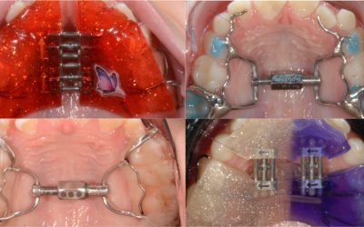 Expanders for Children: The Different Types, and How to Think About Them