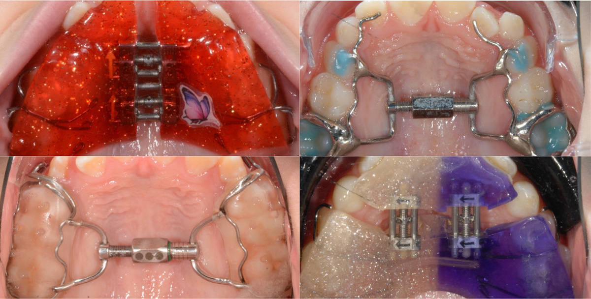Four upper expander appliances seen from above: a coloured removable plate, a banded hyrax, a removable plate with a midline screw, and a two-screw plate